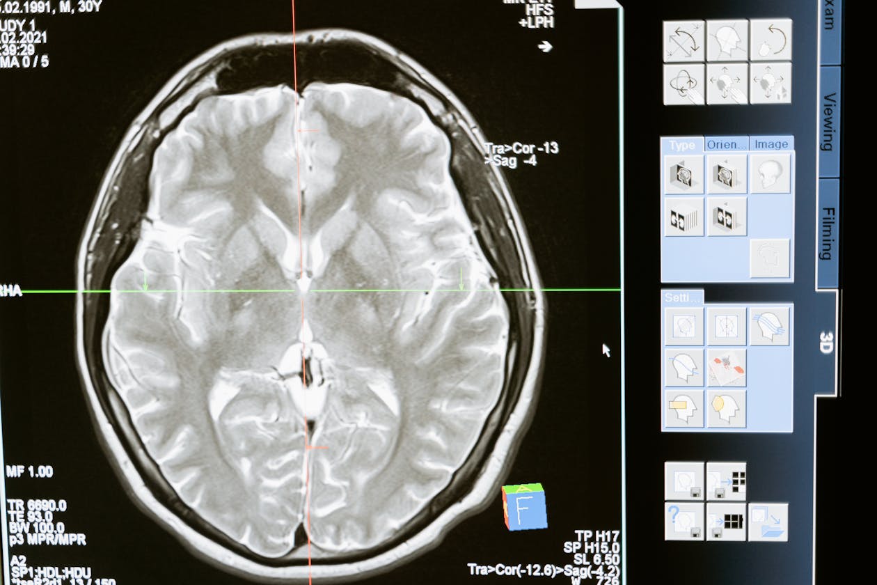 First KRAS G12D Protein Degrader Shows Promise in Pancreatic Cancer — NEJM Phase 1 Data (2026)
